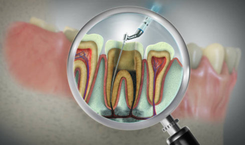 Root Canal Treatment Myths That Stop People from Saving Their Teeth