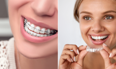 Braces vs Clear Aligners: Which Is Better for Adult Teeth Straightening?