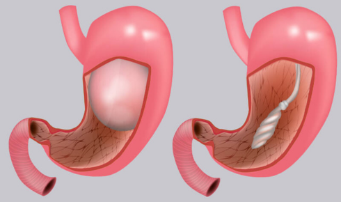 What It Really Costs to Start a Gastric Balloon Journey (And What People Don’t Always Tell You)
