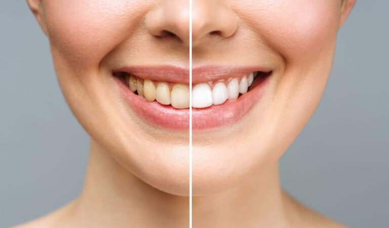 Teeth whitening